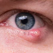 Abnormal Swellings around Eyelids