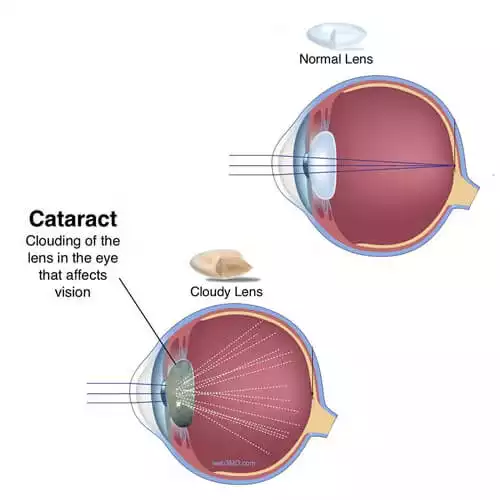 Cataract Eye Surgery