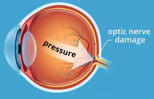 Optical Nerve damage caused by Glaucoma