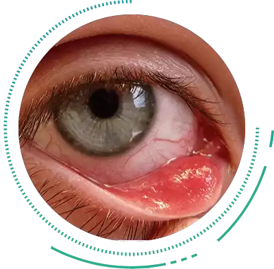 Chalazion Eye Condition