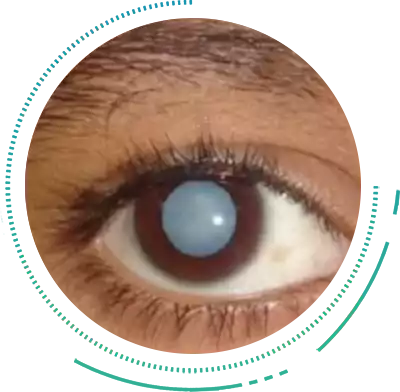 Congential Cataract Eye