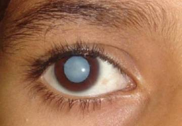 Congential Cataract
