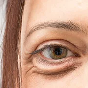 Drooping Eyelids Problem