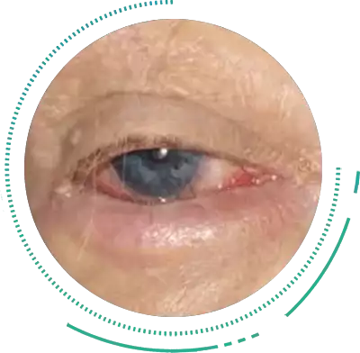 Ectropion & Entropion Eye Condition