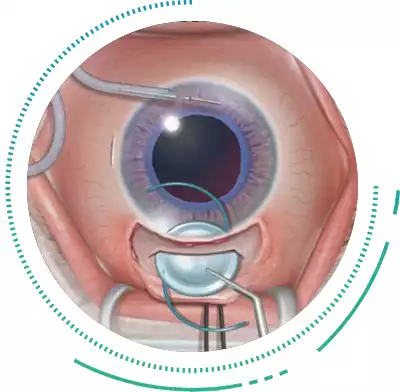 Extracapsular Cataract Surgery