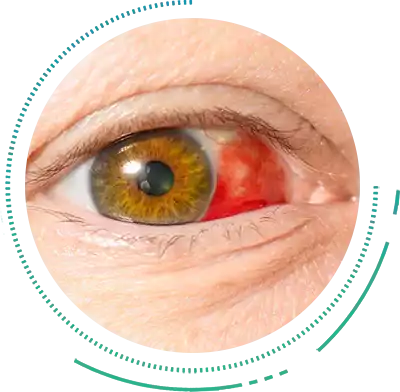 Eye Trauma Complication