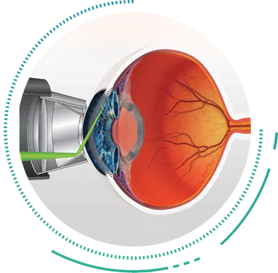 Glaucoma Laser Surgery Procedure