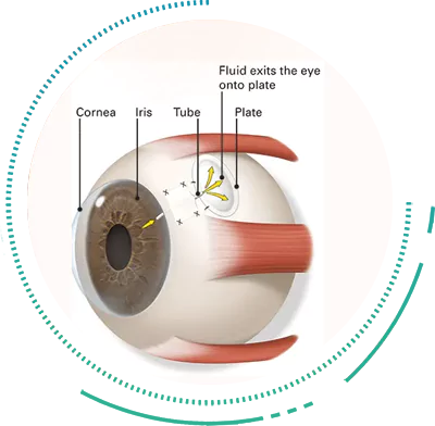 Shunts for Glaucoma Surgery