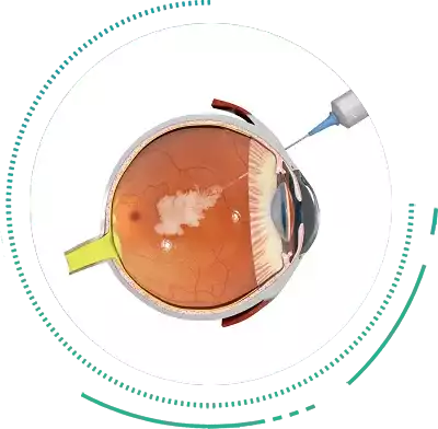 Intravitreal Injections Treatment