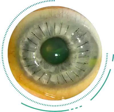 Keratoplasty Lamellar Penetrating Treatment