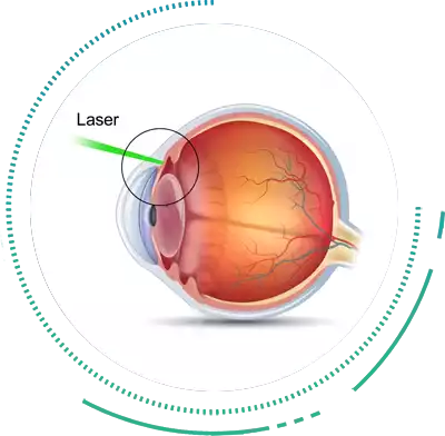 Glaucoma Laser Treatment