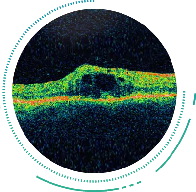 Optical Coherence Tomography Scan