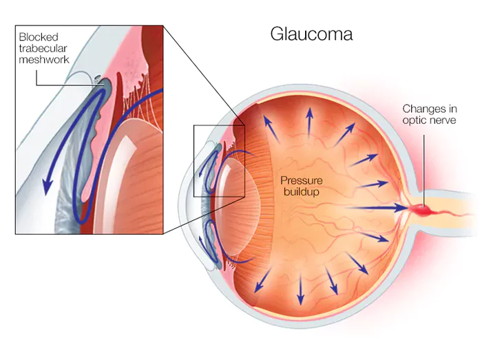 Primary Open Angle Glaucoma Treatment