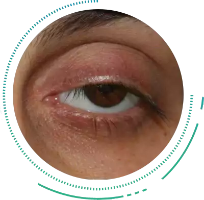 Ptosis Eye Condition