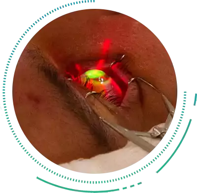 Riboflavin Corneal Collagen Cross Linking Treatment