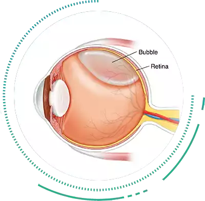 Pneumatic Retinopexy with Scleral Buckling
