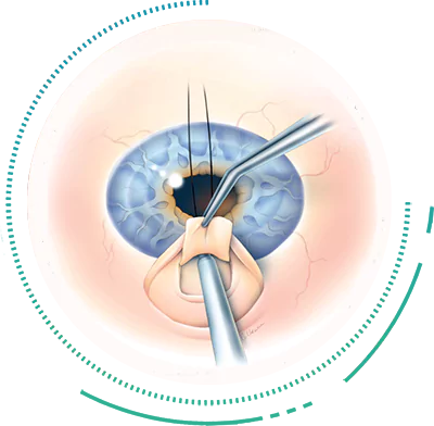 Trabeculetomy Glaucoma Surgery